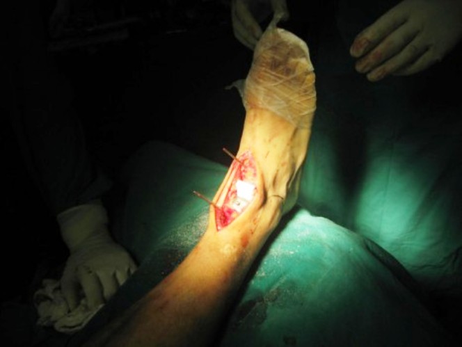 Imagen de la operación al tobillo.